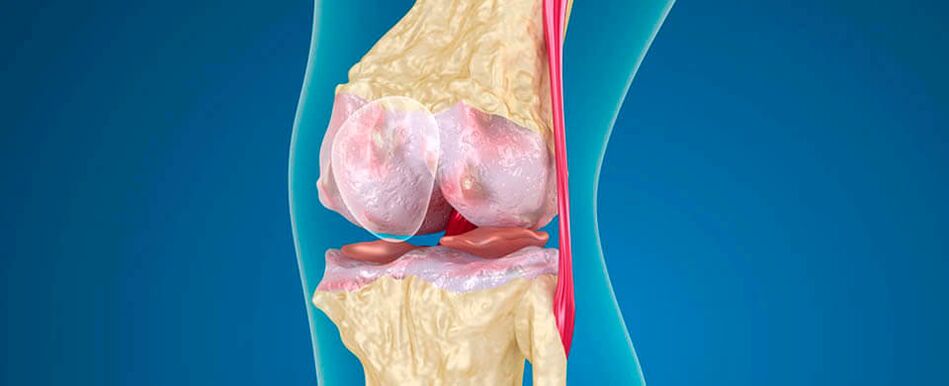 Osteoarthritis of the knee as a cause of pain