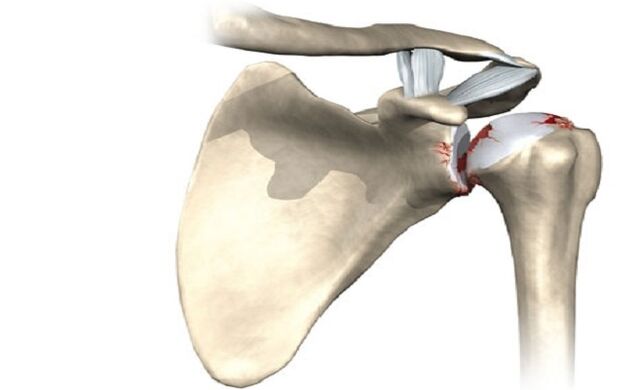 shoulder joint injury due to osteoarthritis