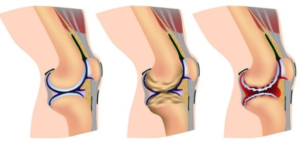 Stages of deformation of knee combination