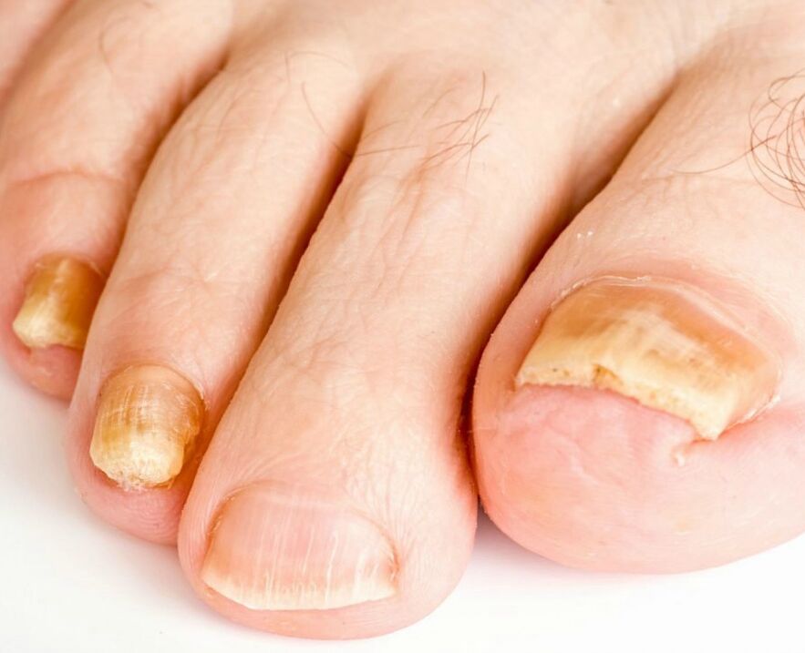 Mushrooms on the nail