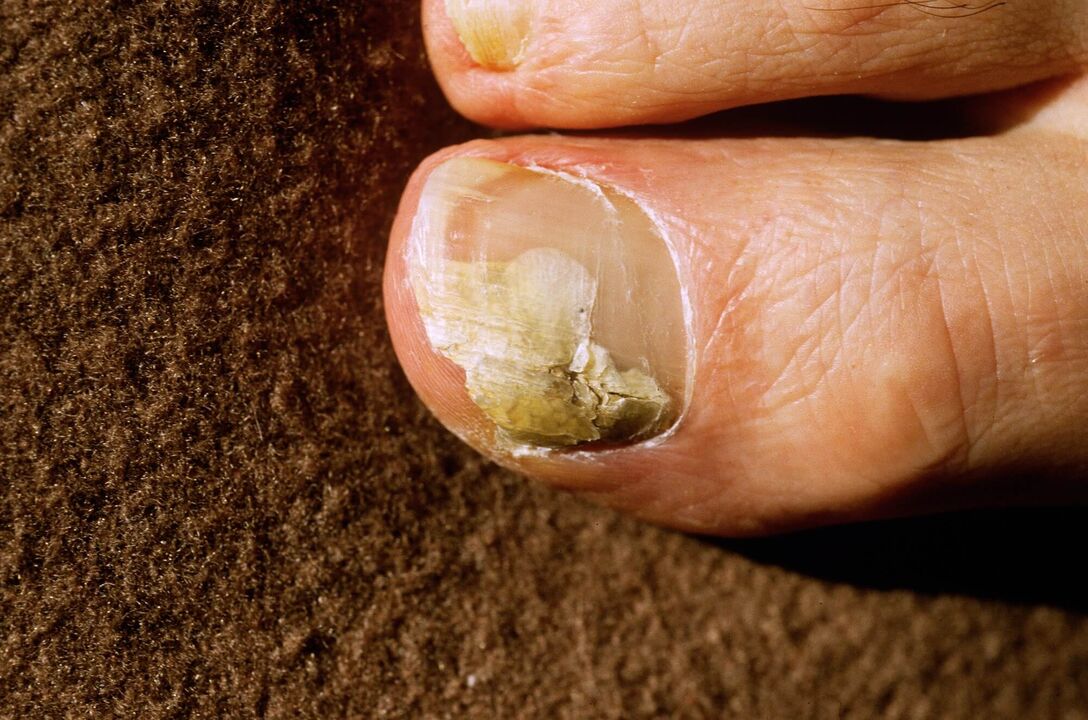 Onyokomycosis