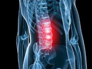 Osteocondrosis of the lomber spine