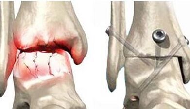 Surgical treatment of knee artosis