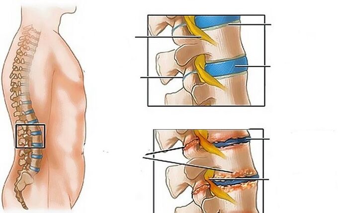 Osteocondrosis of the Lumbar region