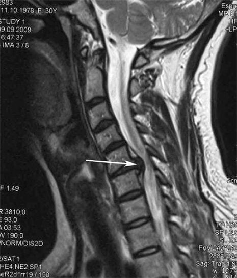 Spinal cord injury causes neck pain