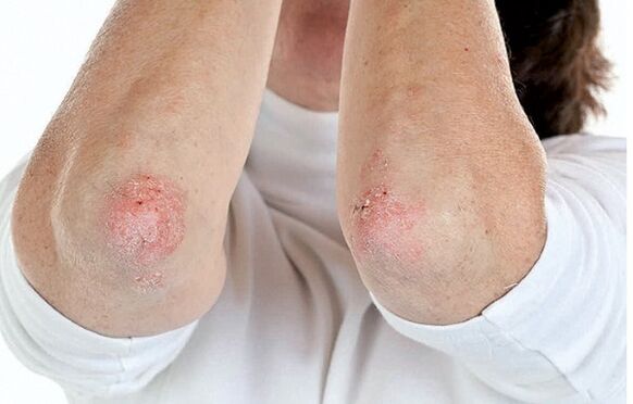 People with psoriasis are susceptible to psoriatic arthritis