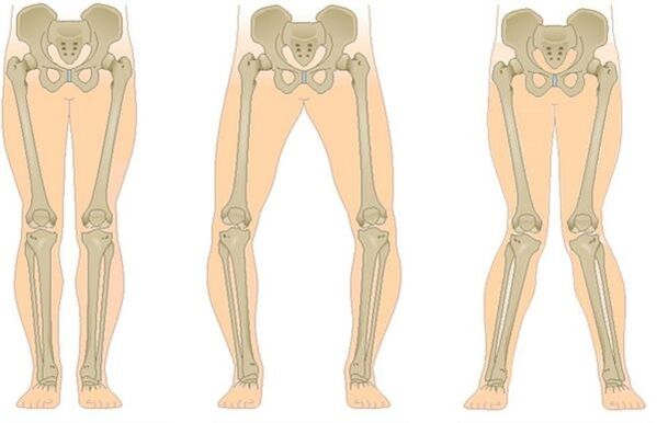 types of arthrosis