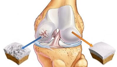 Reasons for the development of arthrosis of combinations