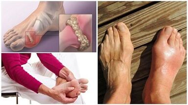 What is the arthritis of joints